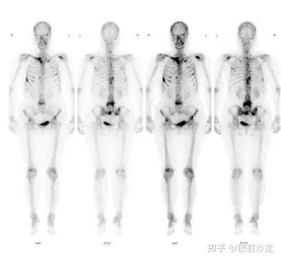 癌症火化骨頭